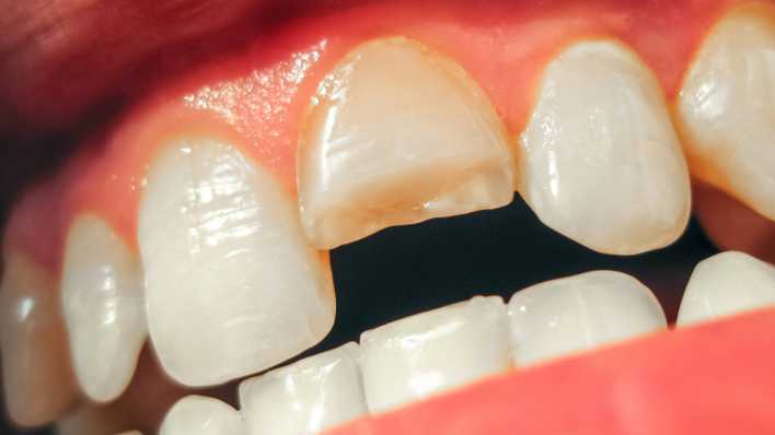 Abgebrochener Zahn