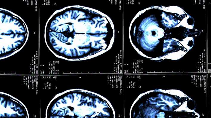 Gehirn-Scan eines MS-Patienten