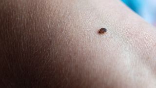 Eine Bettwanze beißt in einen Arm.
