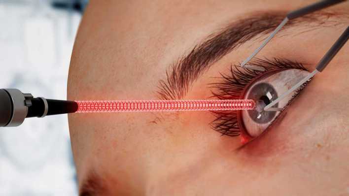 Symbol: Laser-OP am Auge (Bild: IMAGO/Zoonar)