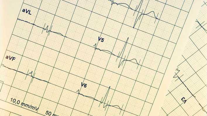 Ein EEG zeigt eine Herzrhythmusstörung an (Bild: picture alliance / Westend61 | Stefan Rupp)