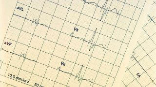 Ein EEG zeigt eine Herzrhythmusstörung an (Bild: picture alliance / Westend61 | Stefan Rupp)