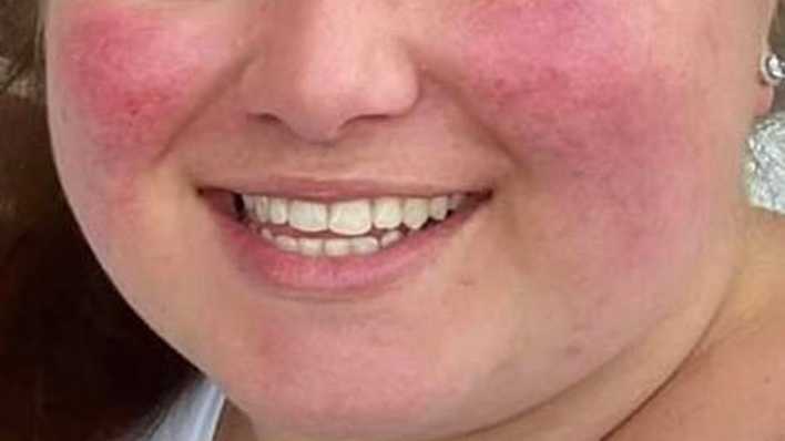 Junge Frau mit dem "Cushion Syndrom"