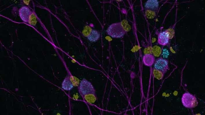 Induzierte menschliche sensorische Nervenzellen: Der neu entdeckte Ionenkanal Elkin1 (cyan), Zellkerne (gelb) und Neurofilament 200 (magenta) (Bild: Amy Hulme, University of Wollongong)