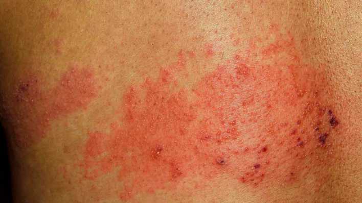 Gürtelrose oder Herpes zoster bei einem 56-jährigen Mann (Bild: picture alliance / imageBROKER)